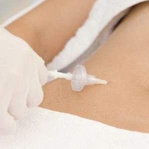 Carboxiterapia