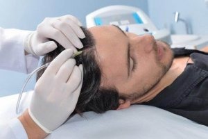 Carboxiterapia Capilar (Pérdida de cabello Femenina y Masculina)